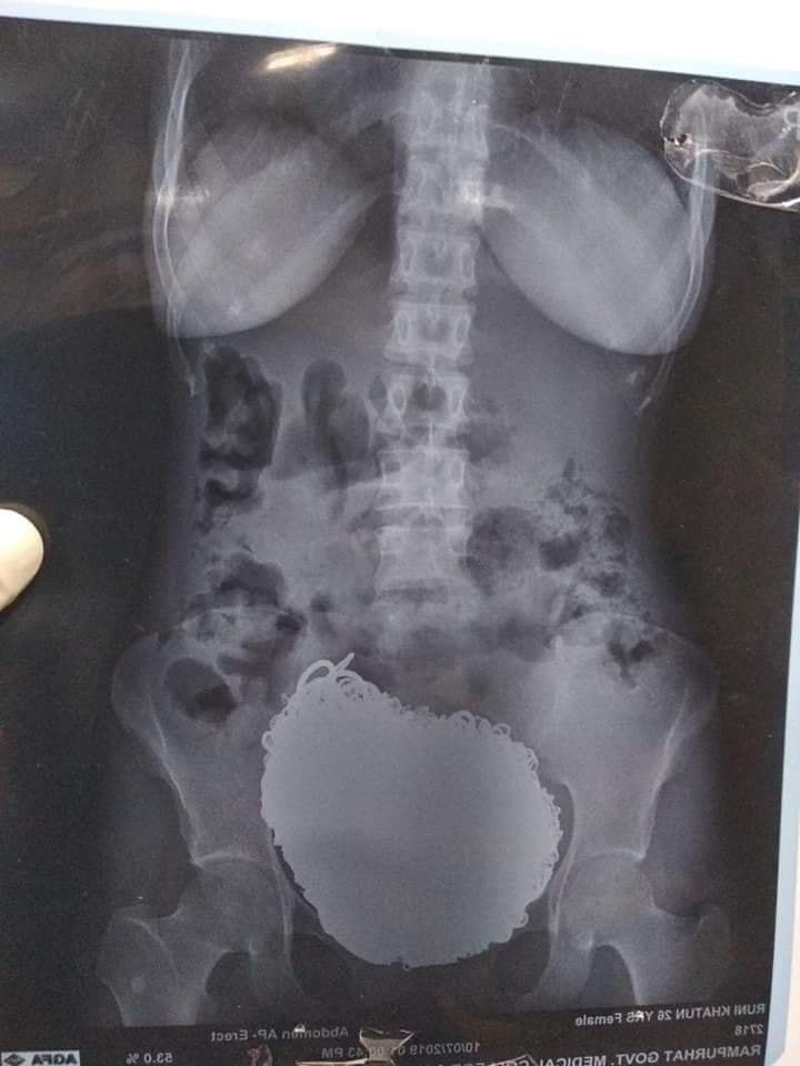 A mass of coins is shown inside a woman’s stomach at Rampurhat Government Medical College and Hospital in India.