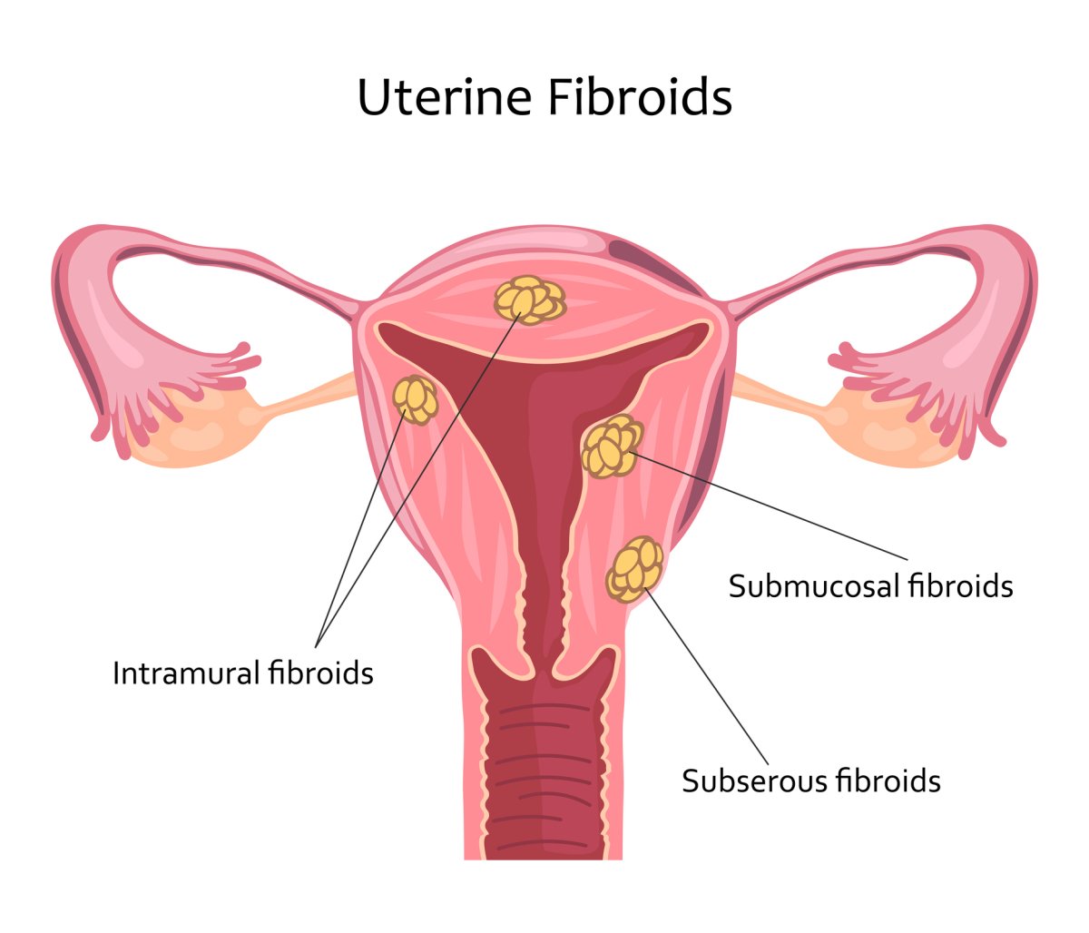 what-are-fibroids-here-s-what-women-need-to-know-national