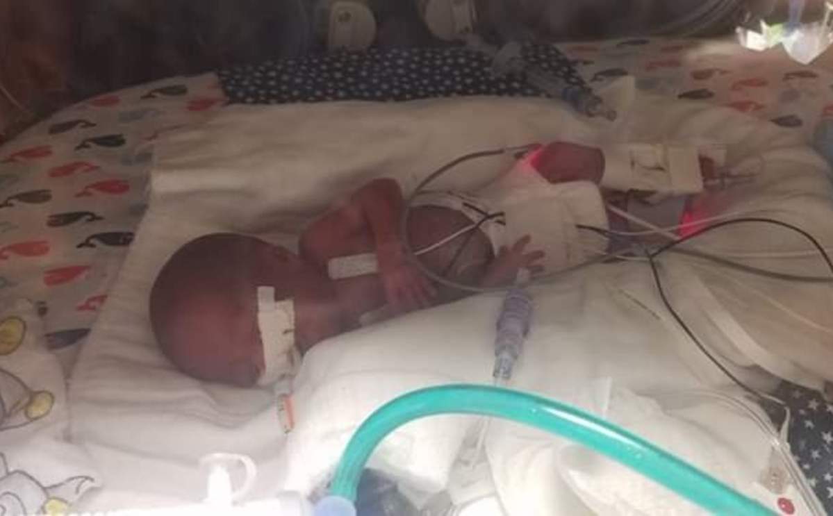 The baby has to remain in NICU until his actual due date in November.