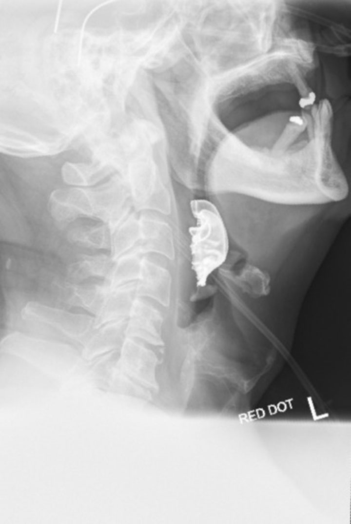 A neck X-ray showing a man’s dentures caught in his throat.