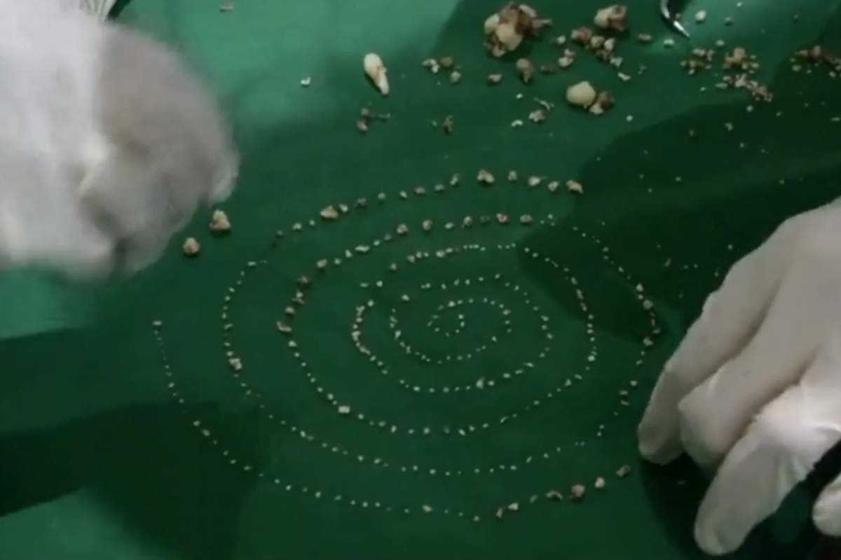 Hundreds of teeth of various sizes are shown after they were removed from a young boy’s mouth in Chennai, India, in this image from video taken on July 31, 2019.