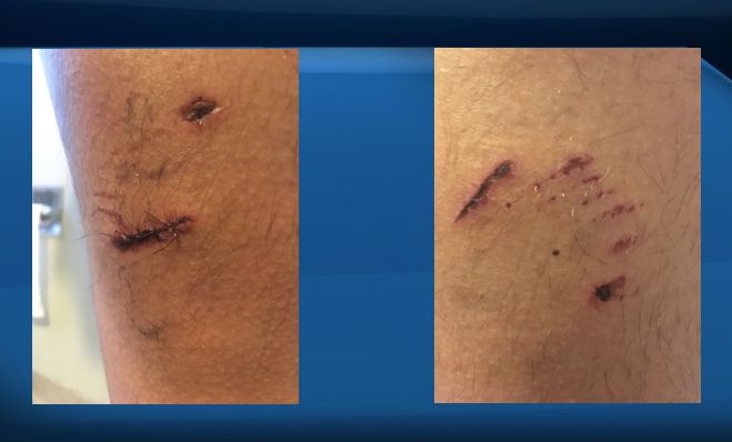 Tyrone Cattleman shared photos of his injuries after being attacked by dogs on Montana First Nation.