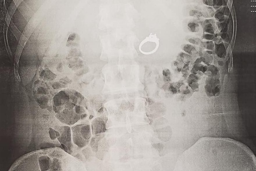 A ring is shown in Jenna Evans’ stomach in this X-ray photo.