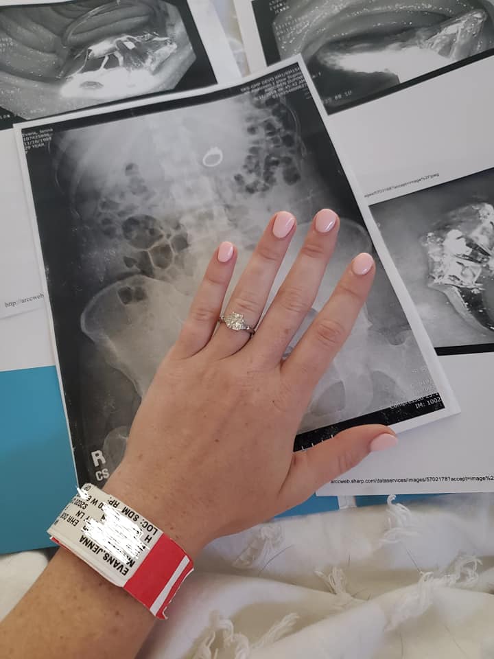 Jenna Evans shows off her engagement ring after it was retrieved from her stomach on Sept. 11, 2019.