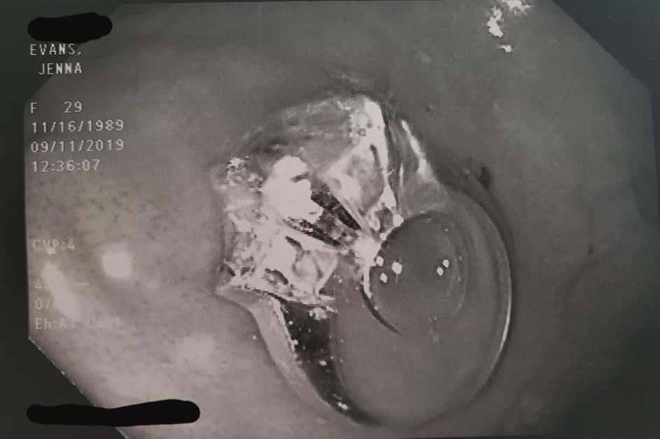 An engagement ring is shown in Jenna Evans’ stomach in this endoscopy photo.