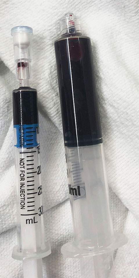 Vials of the woman’s arterial and venous blood, both abnormally dark and tinged blue.