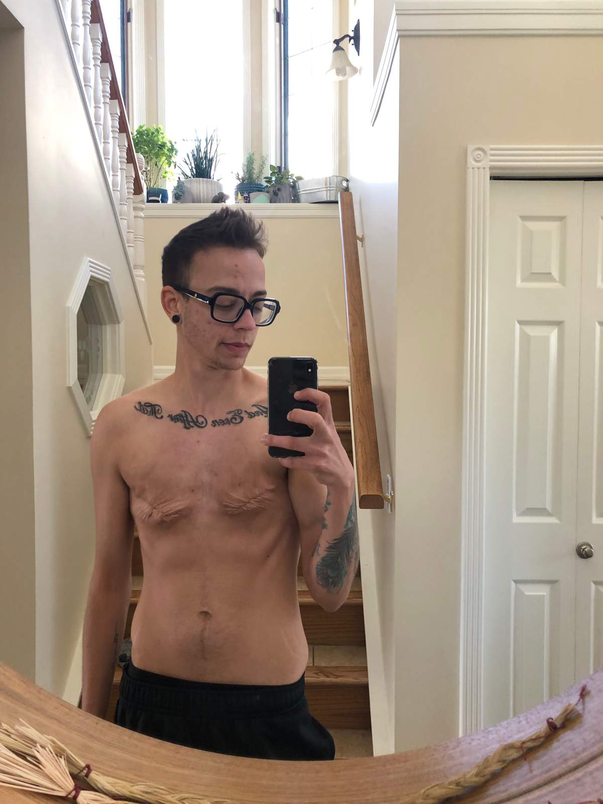 Results post top surgery.