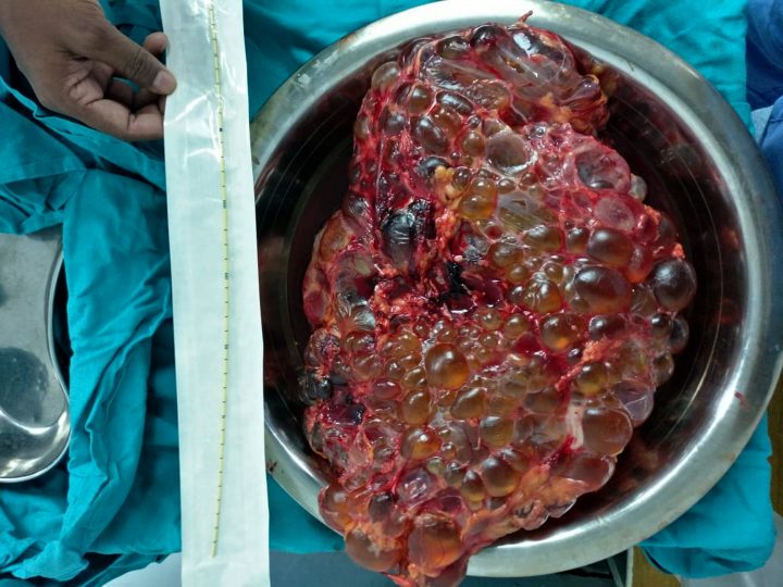 The kidney measured 32 centimetres long by 21.8 centimetres wide.