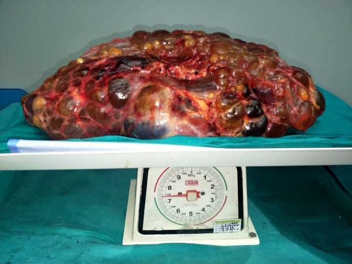 A kidney weighing 7.4 kilograms is shown after it was removed from a patient in Delhi, India on Nov. 26, 2019.