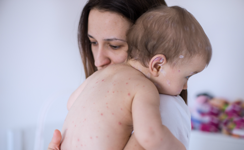 Measles case in Halifax area prompts vaccine reminder from health officials