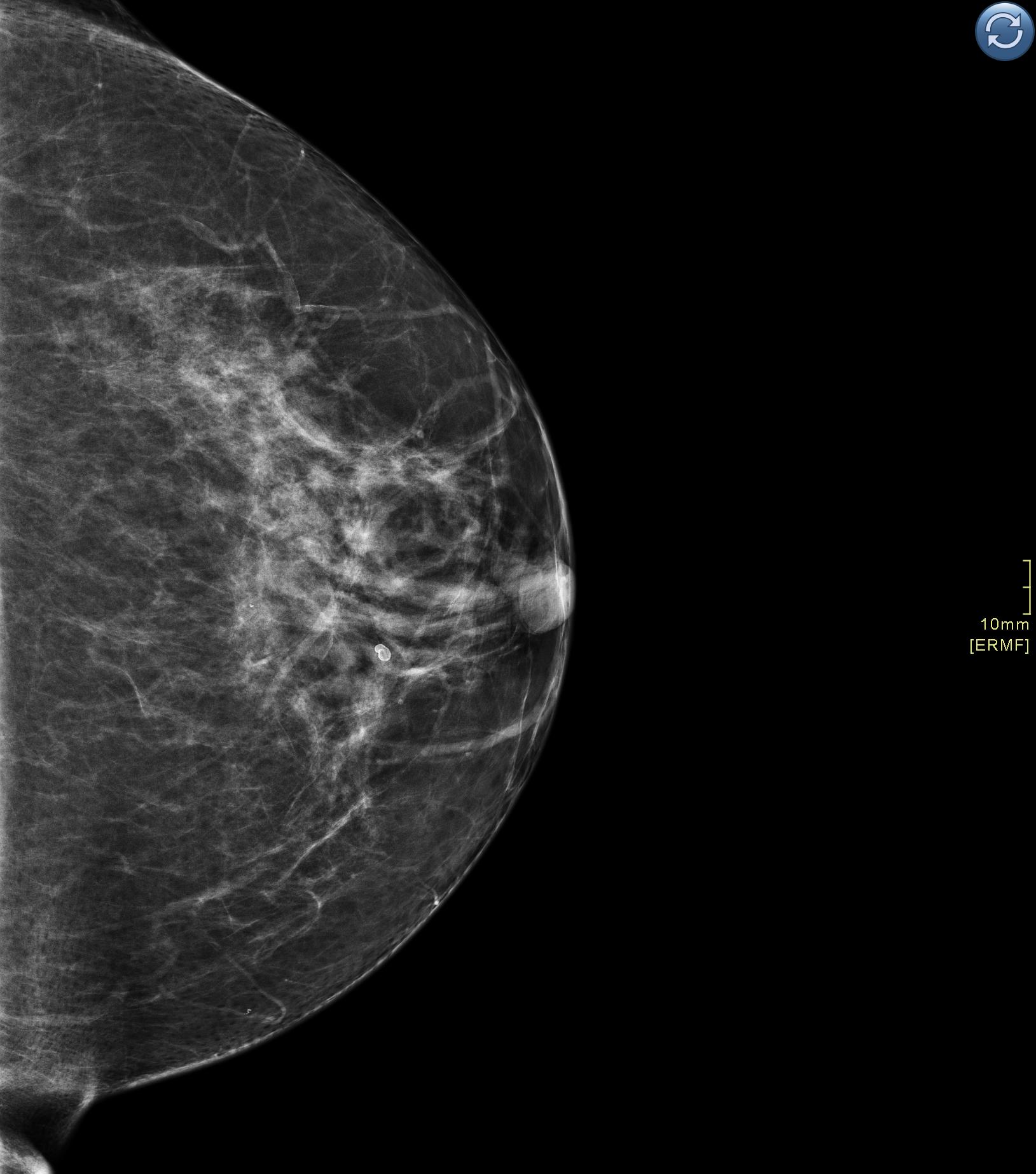 2d-mammogram-globalnews-ca