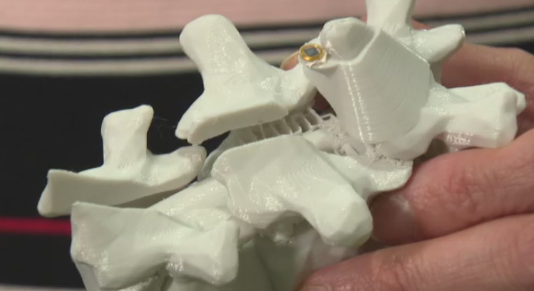 An implant developed at the University of Alberta could be the next step in helping people with spinal cord injuries walk again.