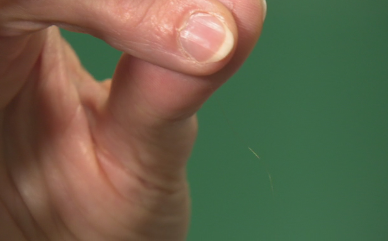 The wire implant is so thin it is only visible as a small glisten by Global News ENG cameras.