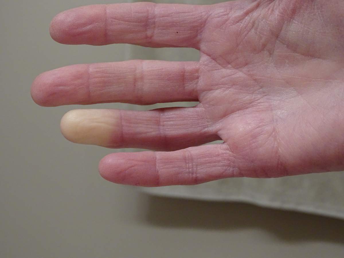 An adult hand with Raynaud’s syndrome. Photo: Getty Images