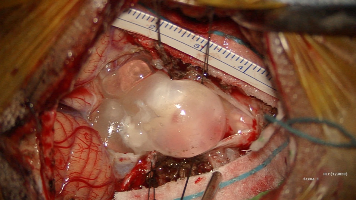 Surgeons remove a tapeworm from a patient’s brain in Elgin, Texas.