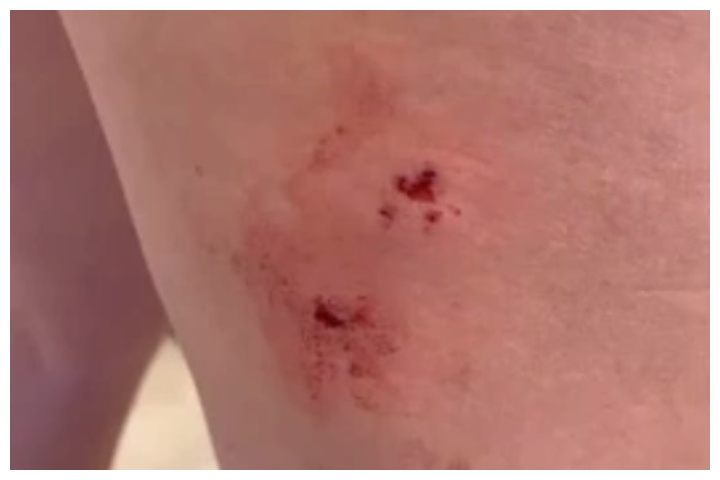 Sharlene French-Amezquita shows the squirrel bite on her leg that required stitches.