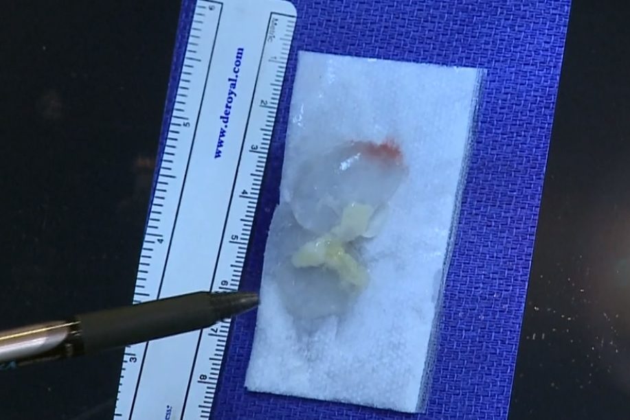 Doctors show the remains of a tapeworm removed from a patient’s head in Elgin, Texas.