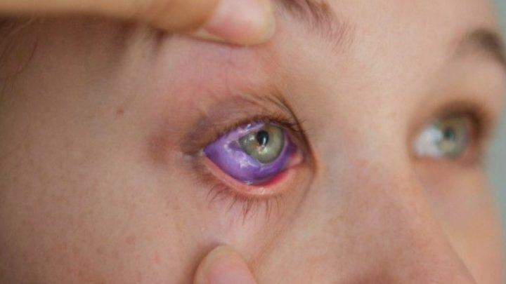 Saskatchewan government bans cosmetic eye tattooing, jewelry implantation