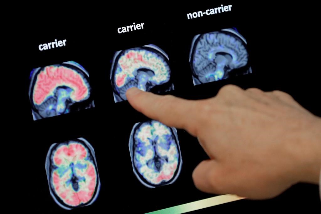 FILE - In this Aug. 14, 2018 file photo, a doctor looks at a PET brain scan.