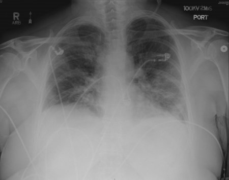 This is what can happen to your lungs when you have coronavirus ...