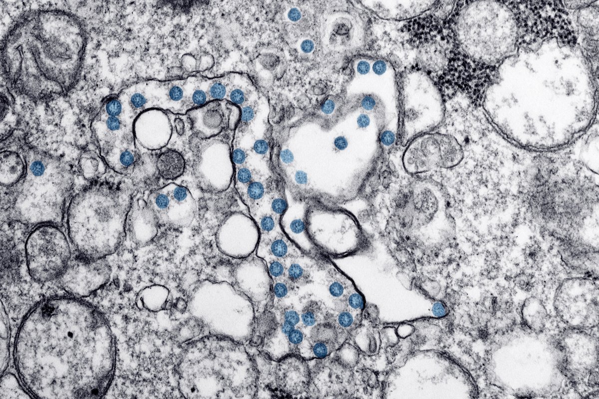Transmission electron microscopic image of an isolate from the first US case of COVID-19, formerly known as 2019-nCoV, a coronavirus.