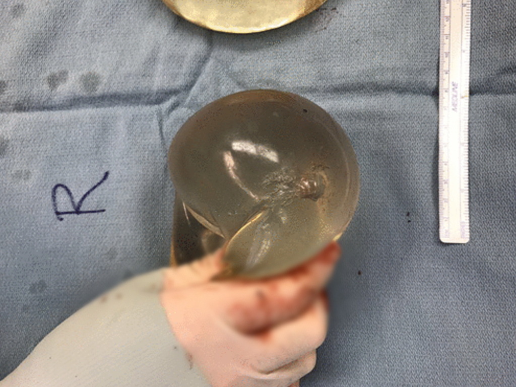 The implant, the Sage Journals study says, deflected the bullet away from her heart, effectively saving her life.