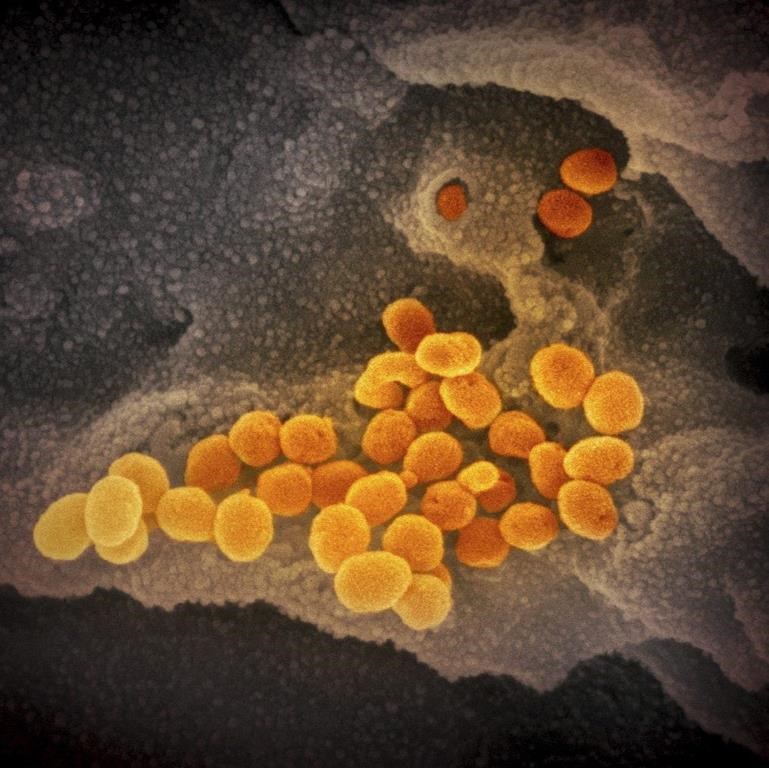 This undated electron microscope image made available by the U.S. National Institutes of Health in February 2020 shows the Novel Coronavirus SARS-CoV-2, orange, emerging from the surface of cells, gray, cultured in the lab. Also known as 2019-nCoV, the virus causes COVID-19. THE CANADIAN PRESS/AP-NIAID-RML via AP.