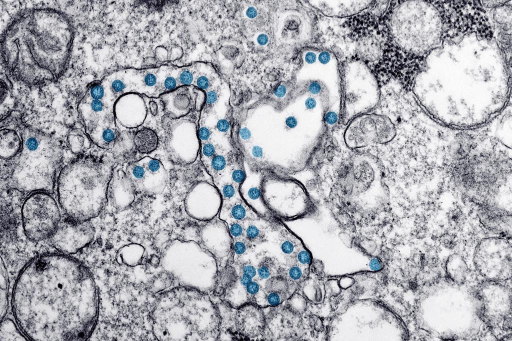 This 2020 electron microscope image made available by the U.S. Centers for Disease Control and Prevention shows the spherical particles of the new coronavirus, colorized blue, from the first U.S. case of COVID-19. THE CANADIAN PRESS/Hannah A. Bullock, Azaibi Tamin/CDC via AP.