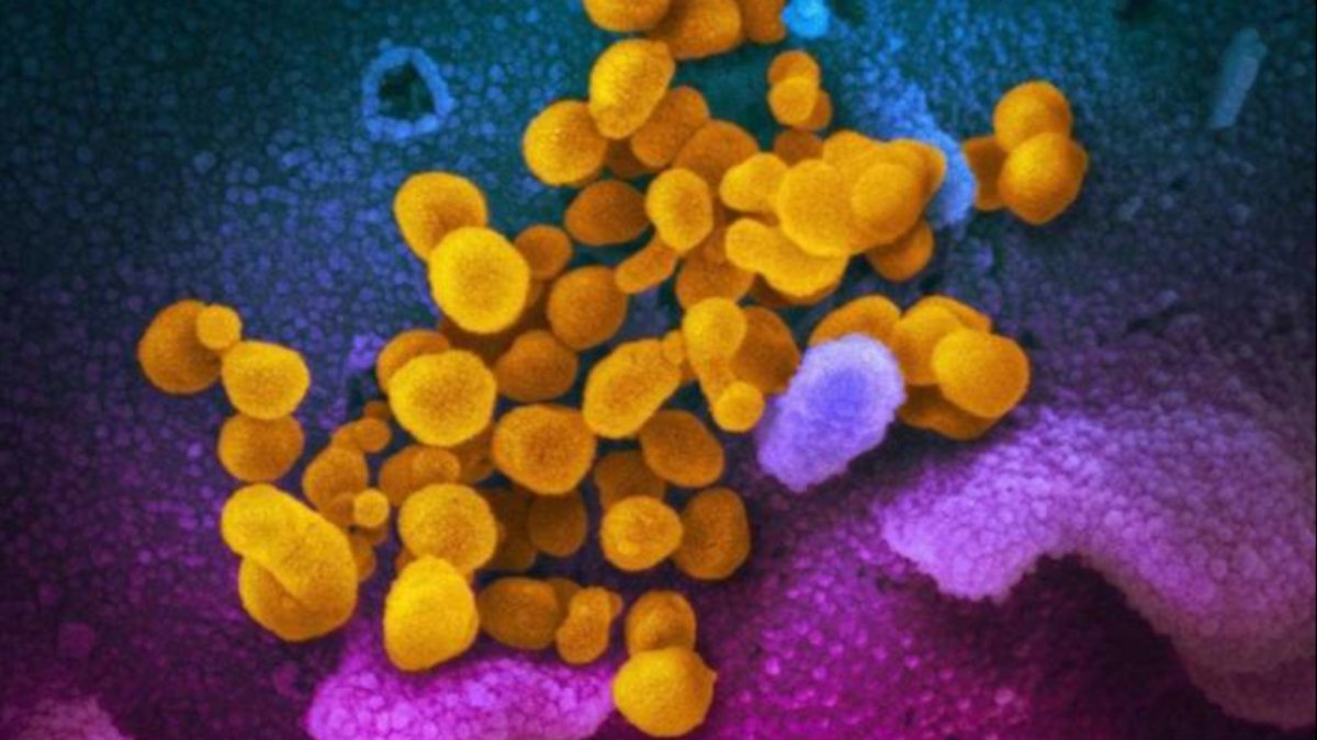 This undated electron microscope image made available by the U.S. National Institutes of Health in February 2020 shows the novel coronavirus SARS-CoV-2, yellow, emerging from the surface of cells, blue/pink, cultured in the lab.