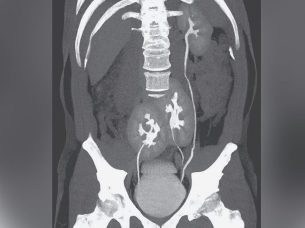Muž v Brazílii se dozvěděl, že má tři ledviny poté, co podstoupil CT vyšetření kvůli bolestem dolní části zad. Nahoře CT snímek, na kterém jsou vidět tři ledviny tohoto muže: 