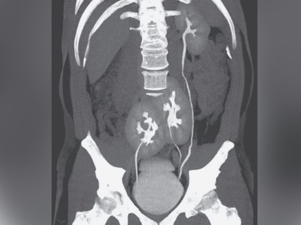 A man in Brazil learned he had three kidneys after receiving a CT scan for low-back pain. Above, the CT scan showing the man’s three kidneys: A normal-appearing kidney on the man’s left side, and two kidneys fused at the pelvis.