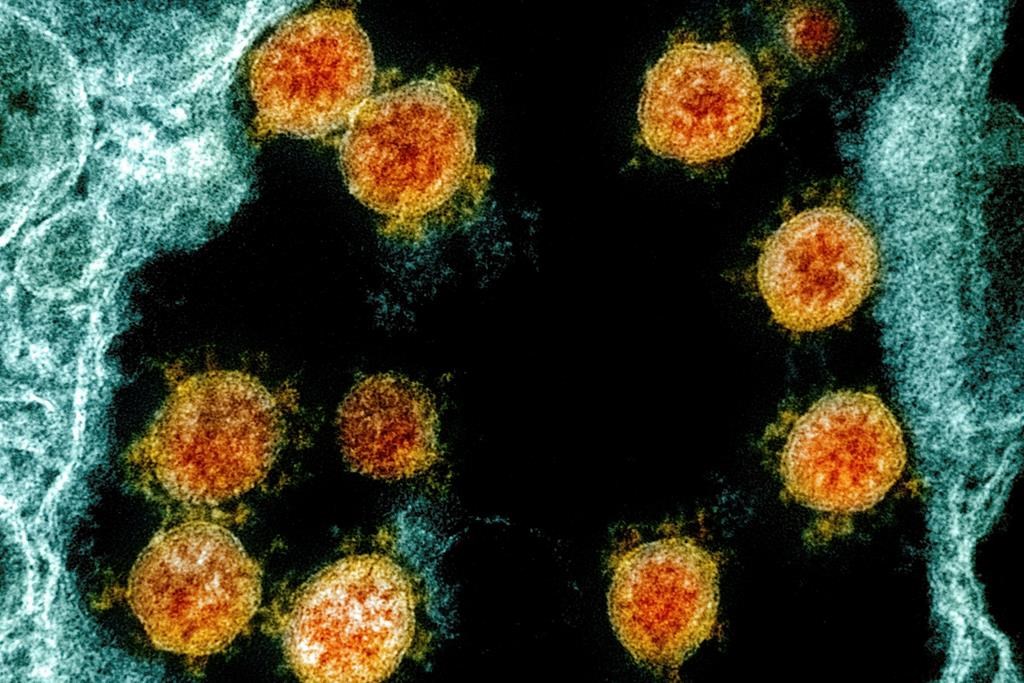 This electron microscope image made available and color-enhanced by the National Institute of Allergy and Infectious Diseases Integrated Research Facility in Fort Detrick, Md., shows Novel Coronavirus SARS-CoV-2 virus particles, orange, isolated from a patient. Research released on Thursday, May 28, 2020 shows how dangerous the coronavirus is for current and former cancer patients. Those who developed COVID-19 were much more likely to die within a month than people without cancer who got it, two studies found.