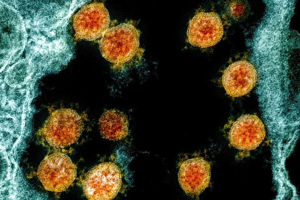 This electron microscope image made available and color-enhanced by the National Institute of Allergy and Infectious Diseases Integrated Research Facility in Fort Detrick, Md., shows Novel Coronavirus SARS-CoV-2 virus particles, orange, isolated from a patient. THE CANADIAN PRESS/AP-NIAID/National Institutes of Health via AP.