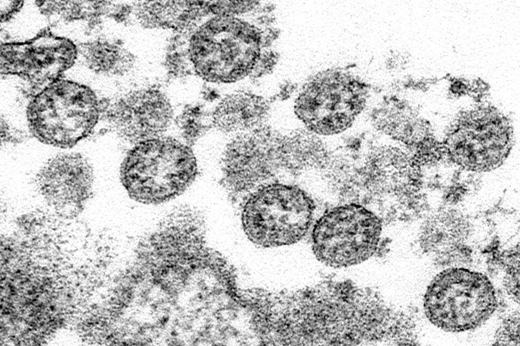 This 2020 electron microscope made available by the U.S. Centers for Disease Control and Prevention image shows the spherical coronavirus particles from the first U.S. case of COVID-19. THE CANADIAN PRESS/AP-C.S. Goldsmith, A. Tamin/ CDC via AP.