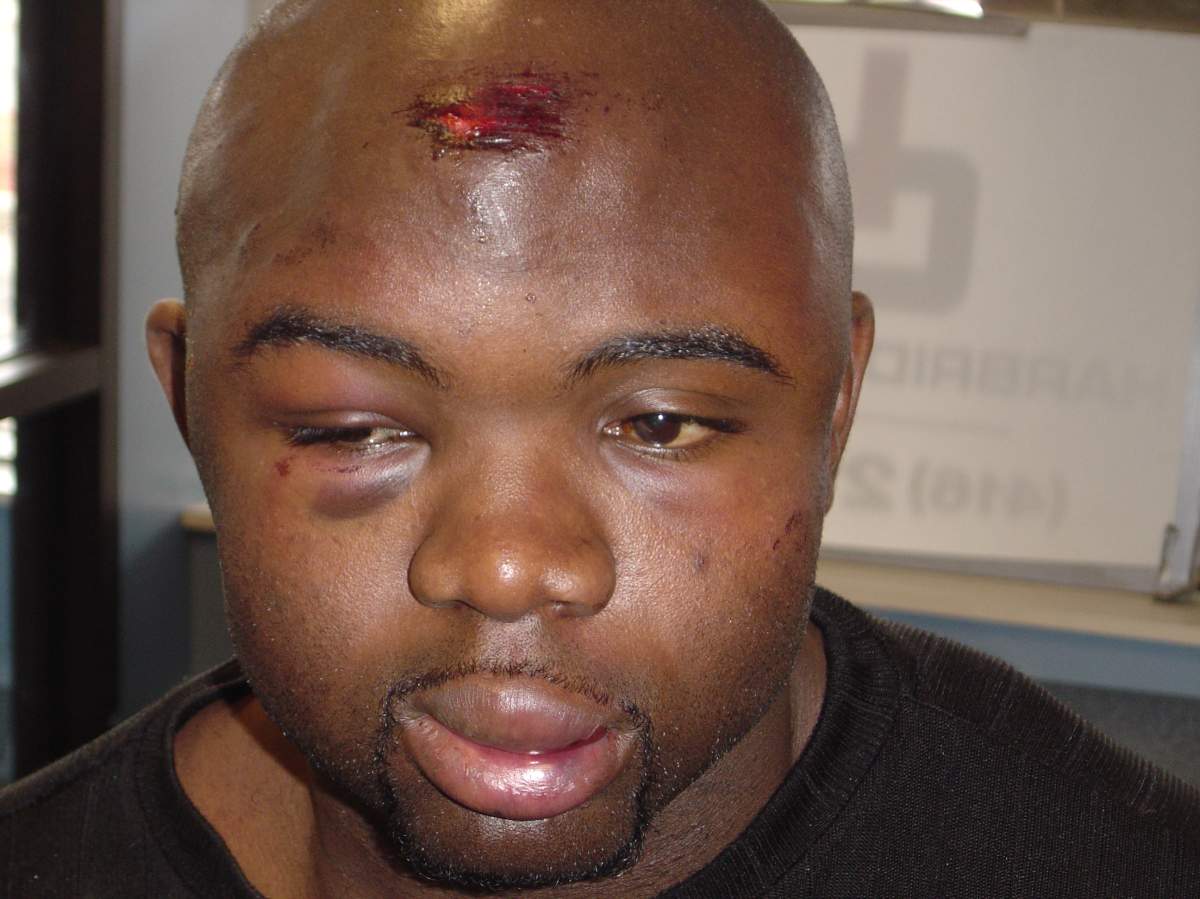 Photos taken of Orlando Bowen’s head injuries the morning after the incident.
