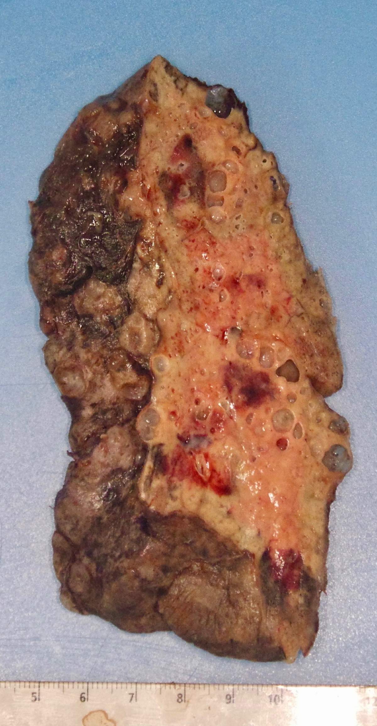 The lung of a COVID-19 patient, showing extensive damage as a result of the disease.