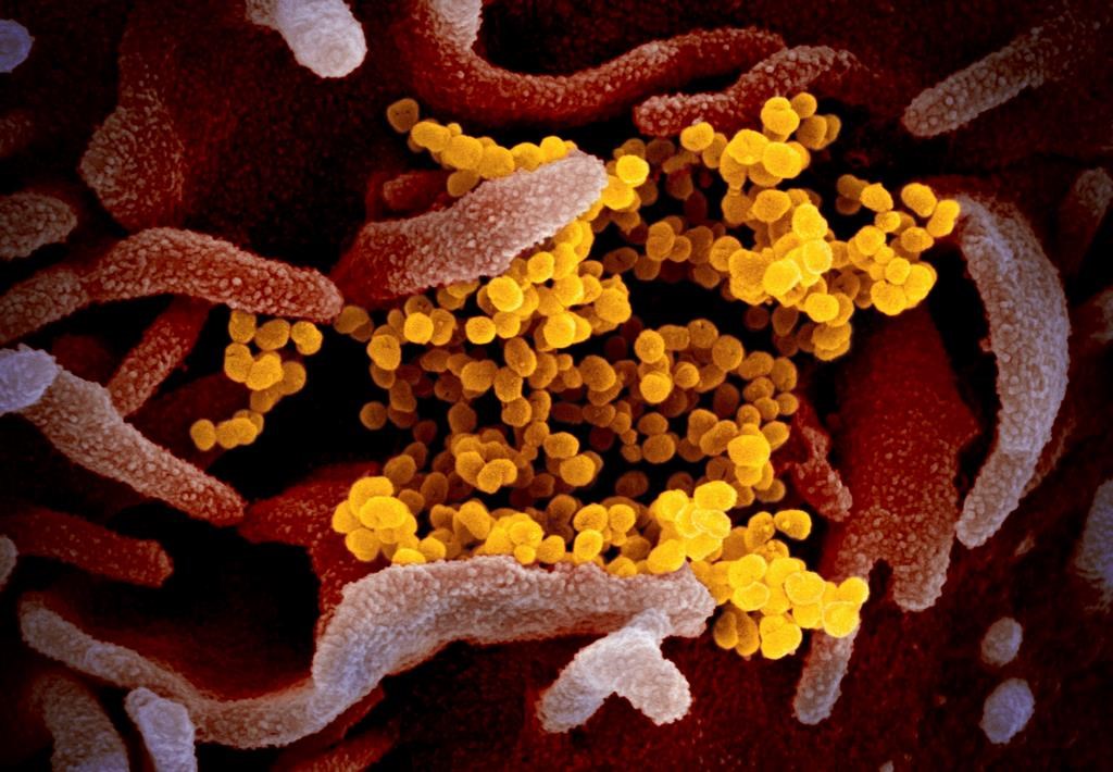 This undated electron microscope image made available by the U.S. National Institutes of Health in February 2020 shows the Novel Coronavirus SARS-CoV-2, yellow, emerging from the surface of cells, pink, cultured in the lab. Also known as 2019-nCoV, the virus causes COVID-19. The sample was isolated from a patient in the U.S. On Thursday, March 5, 2020, Tennessee's Department of Health Commissioner Lisa Piercey confirmed the state's first case of the new coronavirus. (NIAID-RML via AP).