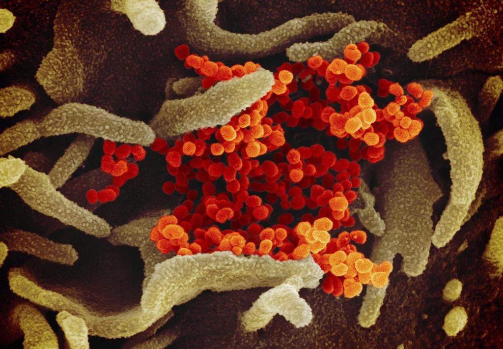 This undated electron microscope image made available by the U.S. National Institutes of Health in February 2020 shows the Novel Coronavirus SARS-CoV-2, orange, emerging from the surface of cells, green, cultured in the lab. Also known as 2019-nCoV, the virus causes COVID-19. The sample was isolated from a patient in the U.S.