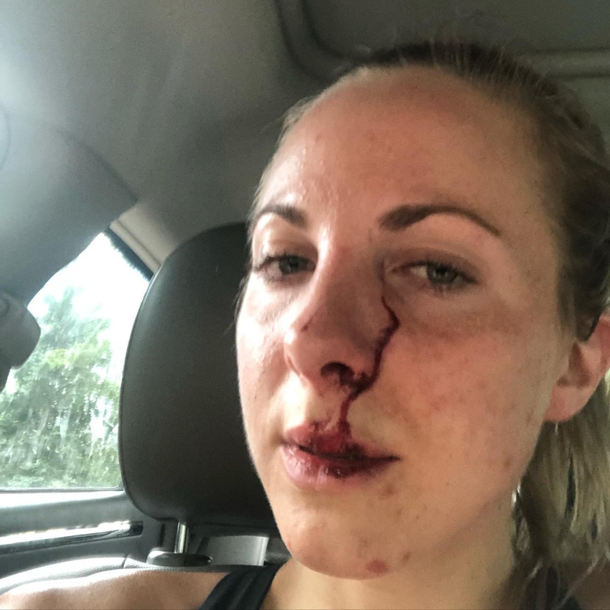 Erin Mckenzie says she's lucky to be alive after an encounter with a black bear in Riding Mountain National Park Monday.