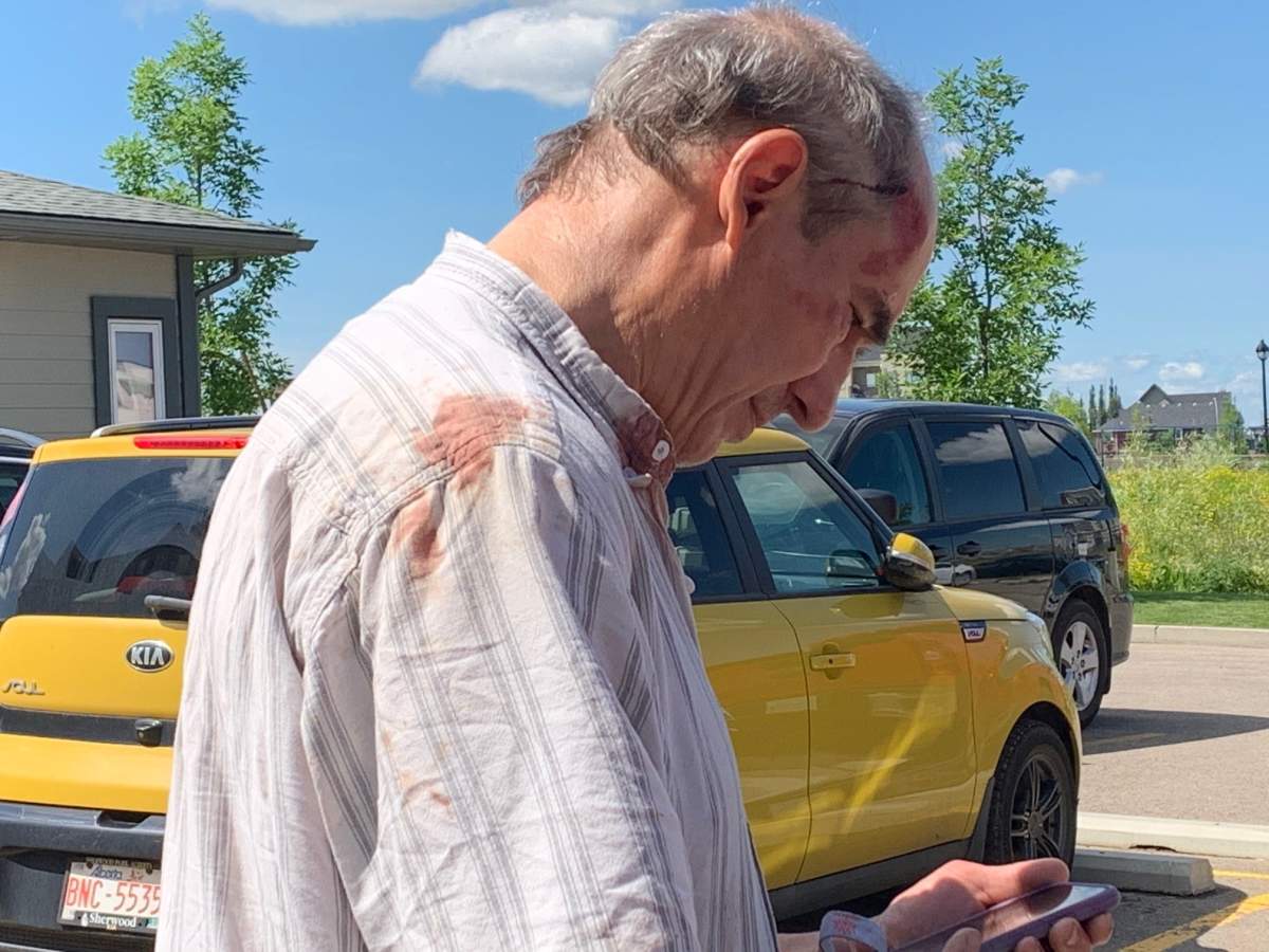 Mike shows reporters the injuries he received as a result of an altercation with an RCMP officer.