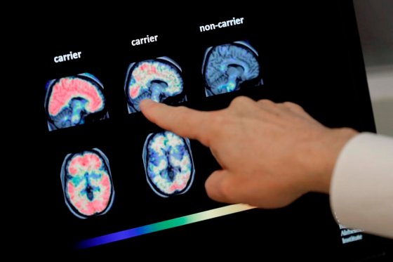 In this file photo, a doctor looks at PET brain scans.