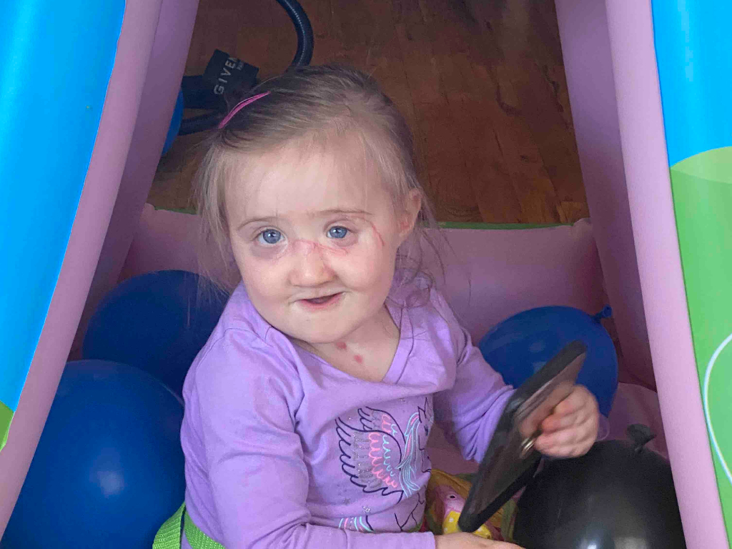 In March 2020, Alessia Sansotta-Ingrasselino was attacked by a pit bull at just 20 months old.