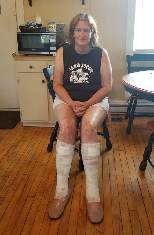 Jenny McLaughlin is shown at her home in Saint-Isidore, N.B. on Thursday, July 30, 2020 in a handout photo. McLaughlin says she was able to survive in woods northeast of the province for nearly two weeks by drinking rainwater from puddles and eating wild berries. THE CANADIAN PRESS/HO-Jenny McLaughlin MANDATORY CREDIT.