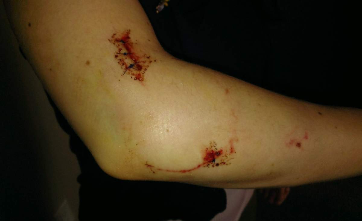 Stephanie Browne’s injuries in 2014.