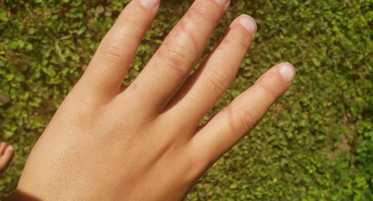 Photo shows dark burn marks on the hand of seven-year-old Maria Legge who was stung by a man-of-war on Lawrencetown Beach.
