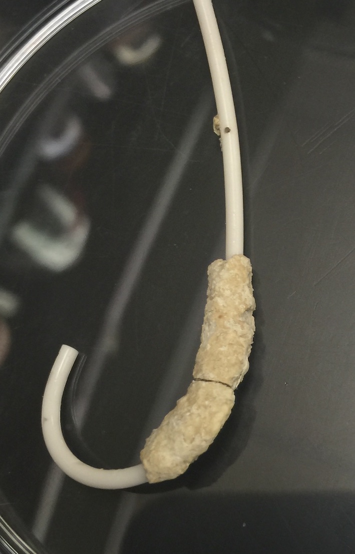 Ureteral stents can often become encrusted