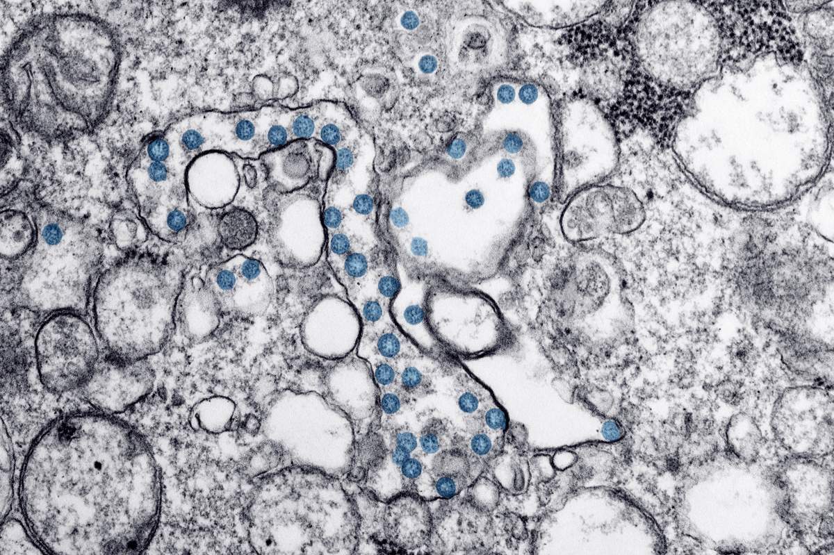 Transmission electron microscopic image of an isolate from the first U.S. case of COVID-19, March, 2020. The spherical viral particles, colorized blue, contain cross-sections through the viral genome, seen as black dots.