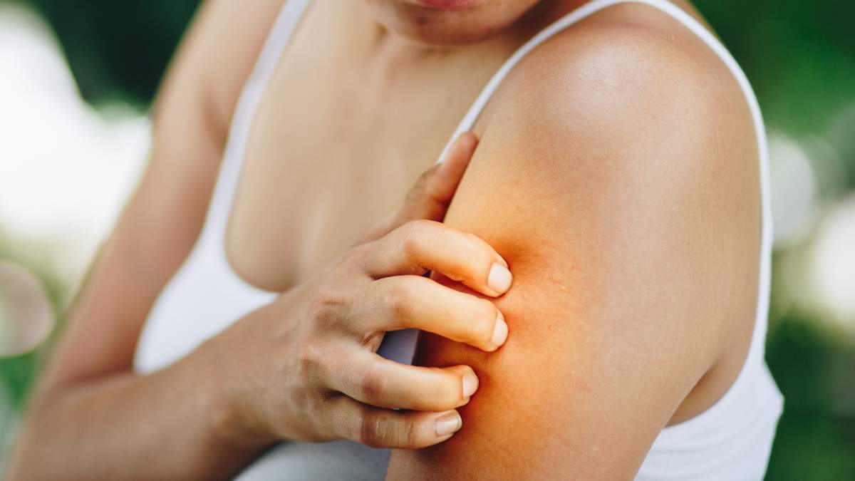 ‘It was really bad’: How eczema affected one woman’s skin and how she coped - image