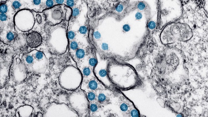 This 2020 electron microscope image made available by the U.S. Centers for Disease Control and Prevention shows the spherical particles of the new coronavirus, colorized blue.