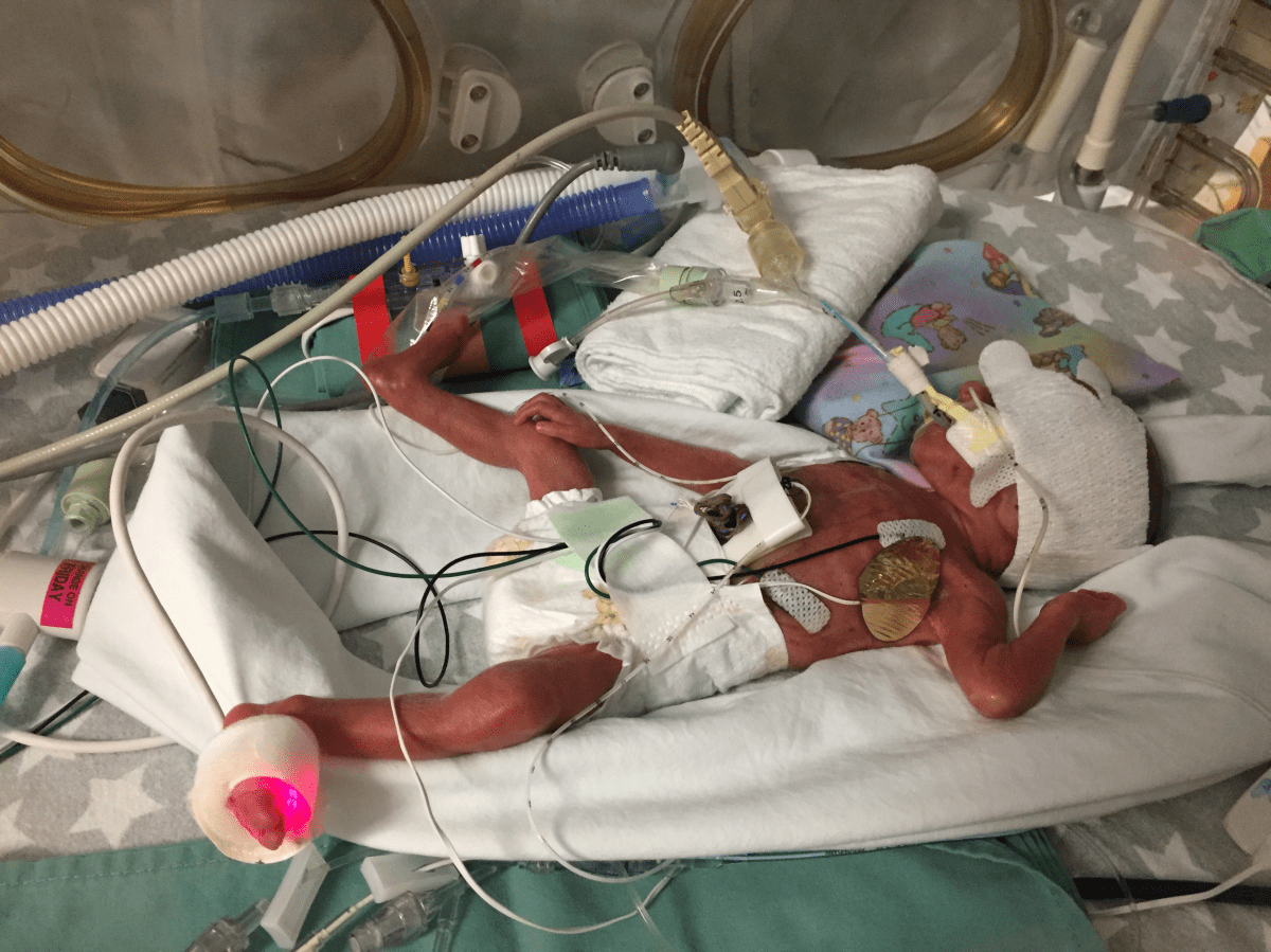 Natalie Ruzesky was born at 24 weeks gestation and weighed one pound and five ounces.
